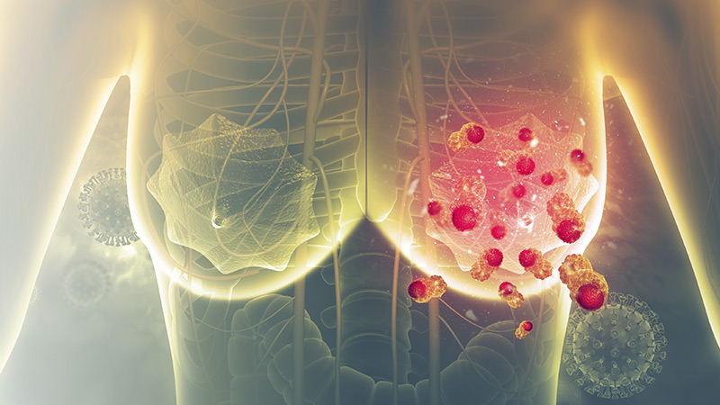 Câncer de mama: guia completo