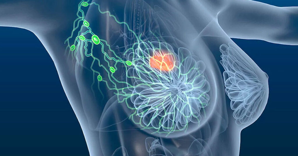 liminar para câncer de mama.