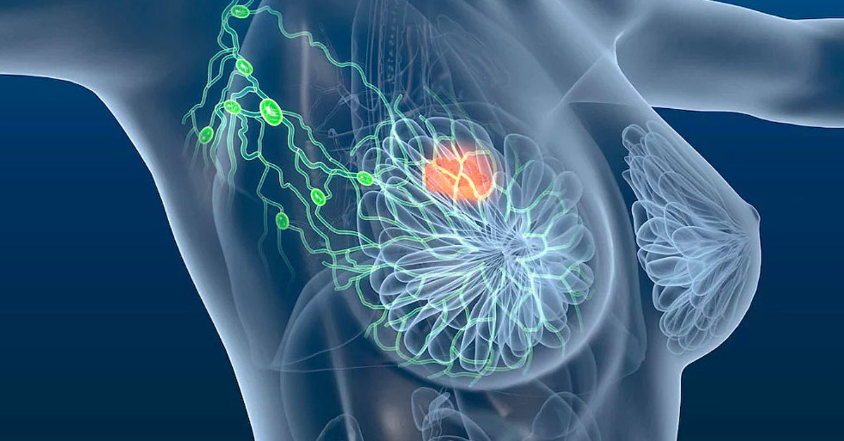 liminar para câncer de mama.