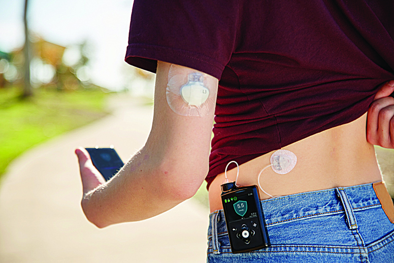 Bomba de Insulina pelo SUS em 2026: Guia completo