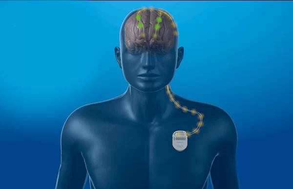 Cirurgia de DBS pelo SUS: como garantir o tratamento de alta complexidade no sistema público