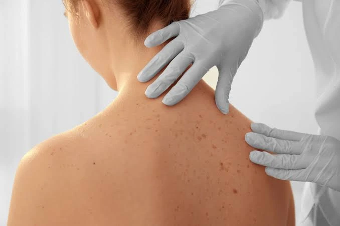 carcinoma basocelular pelo sus