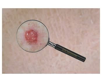 carcinoma basocelular liminar