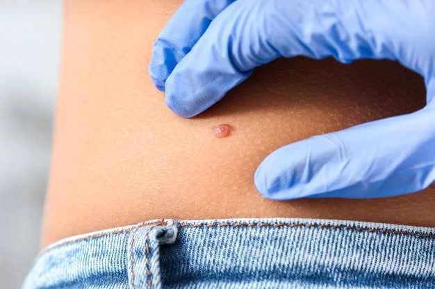 carcinoma basocelular faq