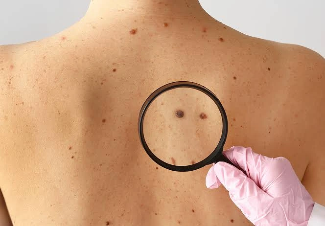 melanoma plano de saude