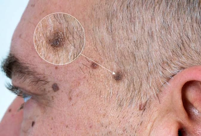 melanoma sus