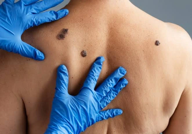 melanoma liminar