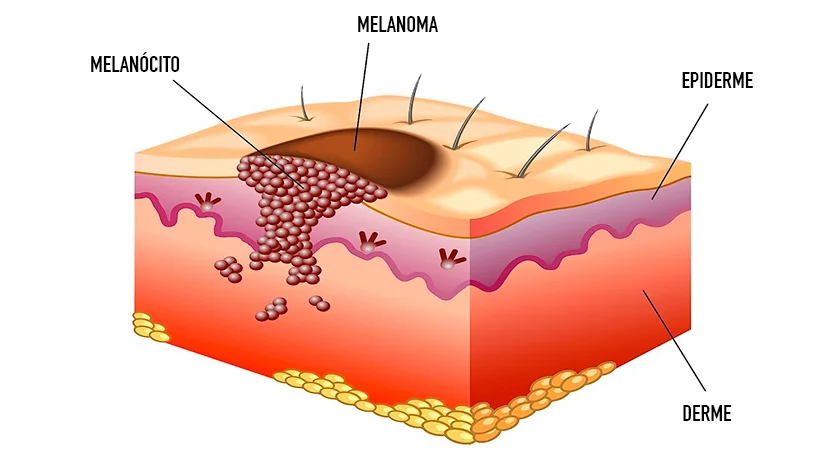 melanoma faq