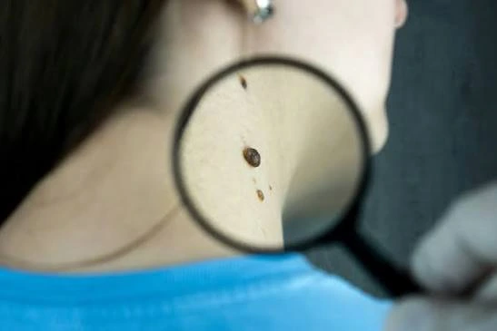 carcinoma basocelular plano de saude