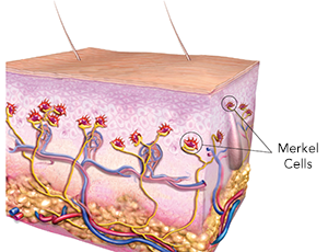 carcinoma de células de Merkel faq