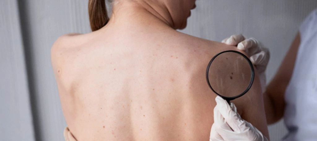 carcinoma de células de Merkel SUS