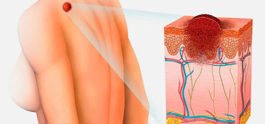 carcinoma espinocelular faq