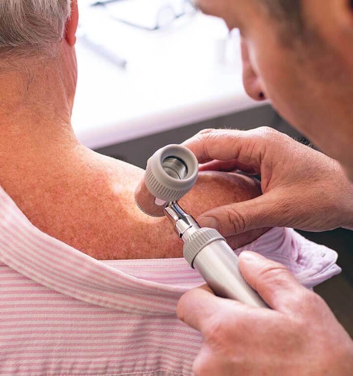 carcinoma espinocelular plano de saude