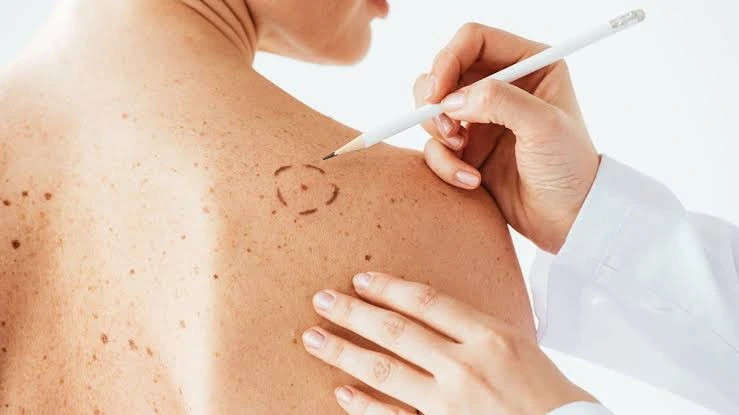 carcinoma espinocelular sus