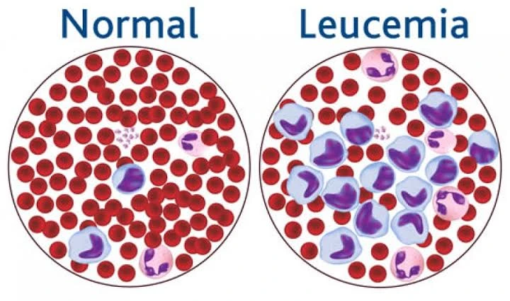 Leucemia mieloide aguda faq