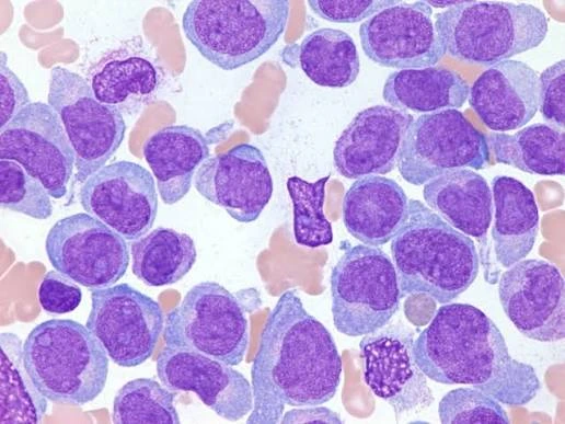 Leucemia Mieloide Aguda liminar