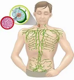 linfoma não-Hodgkin faq